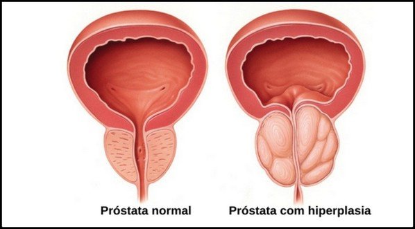 Remédios para Próstata Aumentada: Efeitos Colaterais